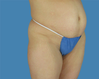 Before LipoTuck™ Sugar Land TX