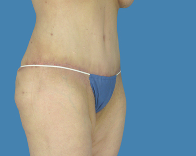 1740677007 body lipotuck p36 row 1 column 2