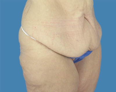 1740677010 body lipotuck p35 row 1 column 1