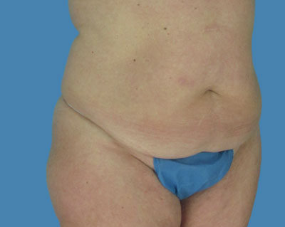 1740677031 body lipotuck p119 row 1 column 1