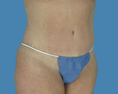 1740677035 body lipotuck p119 row 1 column 2