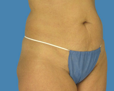 1740677038 body lipotuck p118 row 1 column 1