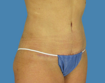 1740677041 body lipotuck p118 row 1 column 2