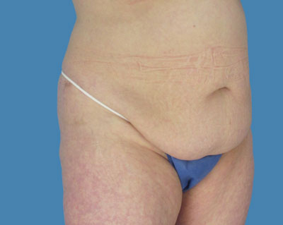 1740677044 body lipotuck p117 row 1 column 1