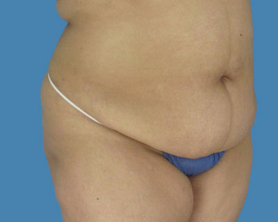 1740677054 body lipotuck p113 row 1 column 1