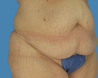 1740677058 body lipotuck p10 row 1 column 1