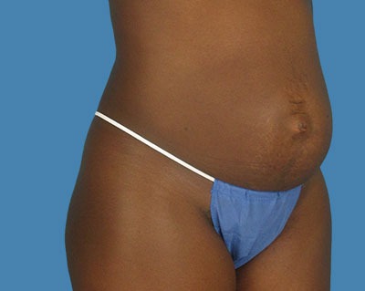 1740677075 body tummy tuck p2 row 1 column 1