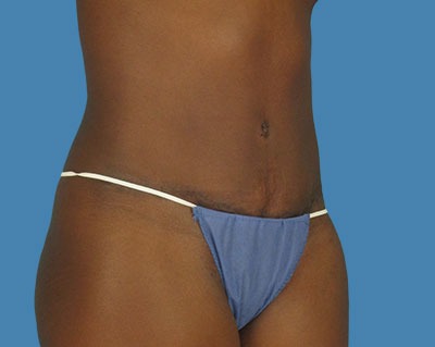 1740677078 body tummy tuck p2 row 1 column 2