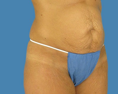 1740677086 body tummy tuck p4 row 1 column 1