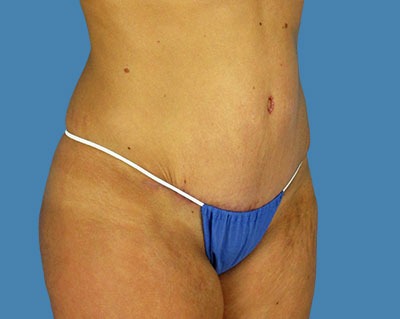 1740677090 body tummy tuck p4 row 1 column 2