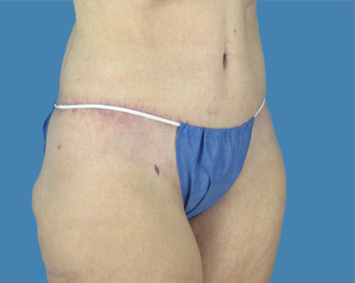 1740677093 body lipotuck p35 row 1 column 2