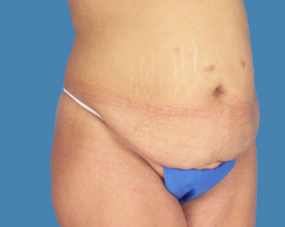 1740677096 body lipotuck p24 row 1 column 1