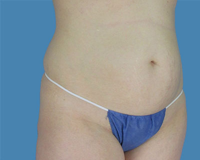 1740677102 body lipotuck p120 row 1 column 1