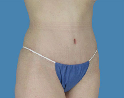 1740677107 body lipotuck p120 row 1 column 2