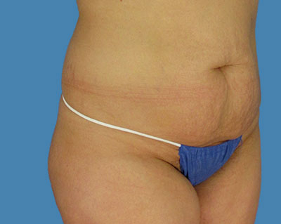1740677110 body lipotuck p12 row 1 column 1
