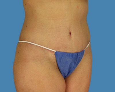1740677115 body lipotuck p12 row 1 column 2