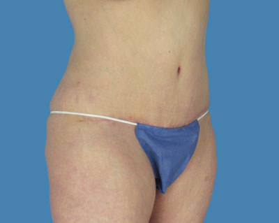 1740677119 body lipotuck p117 row 1 column 2