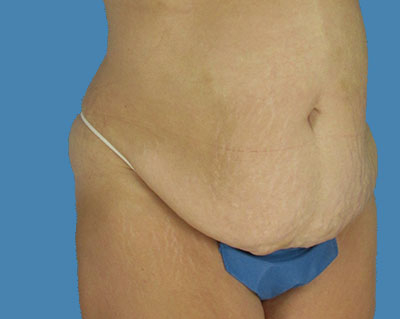 1740677125 body lipotuck p11 row 1 column 1