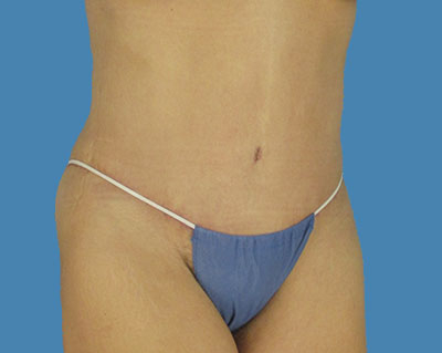 1740677128 body lipotuck p11 row 1 column 2