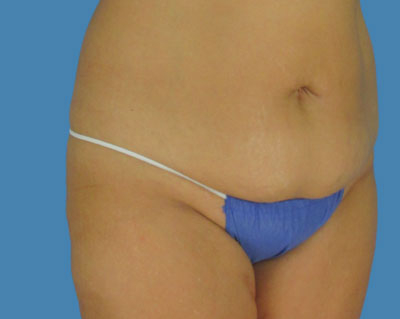 1740677131 body lipotuck p114 row 1 column 1
