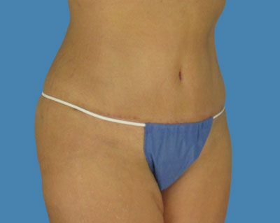 1740677134 body lipotuck p114 row 1 column 2