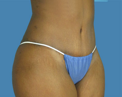 1740677140 body lipotuck p78 row 1 column 2