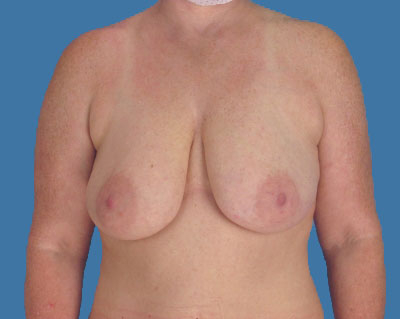 1740677186 breast breast lift p21 3 row 1 column 1