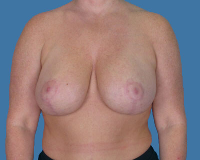 1740677190 breast breast lift p21 3 row 1 column 2