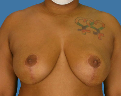 1740677196 breast breast lift p20 2 row 1 column 2
