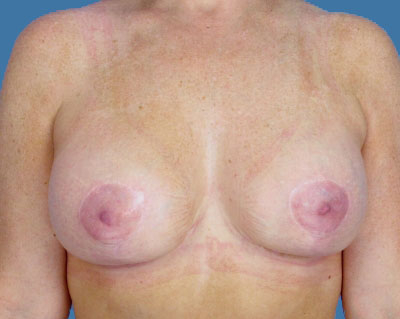 1740677210 breast breast lift p18 2 row 1 column 2