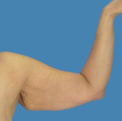 Before Arm Lift Houston TX