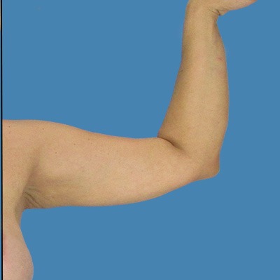After Arm Lift Houston TX