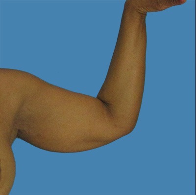 Before Arm Lift Sugar Land TX