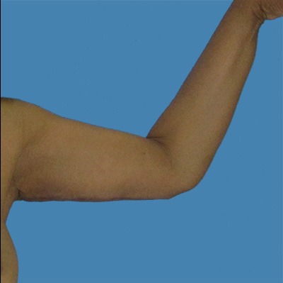 After Arm Lift Sugar Land TX