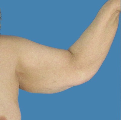 Before Arm Lift Surgery Houston TX