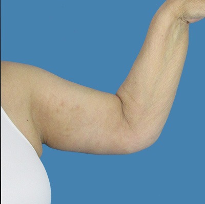 After Arm Lift Surgery Houston TX