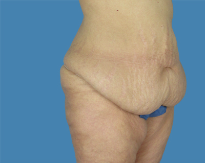 1740677321 body lipotuck p65 row 1 column 1