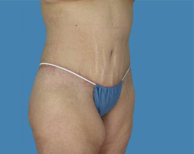 1740677324 body lipotuck p65 row 1 column 2