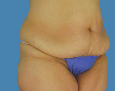 1740677327 body lipotuck p102 row 1 column 1
