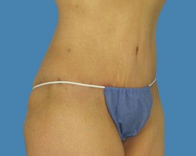 1740677330 body lipotuck p102 row 1 column 2