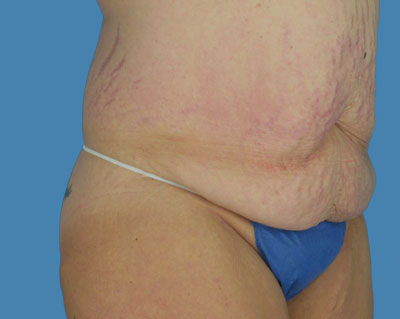 1740677333 body lipotuck p89 row 1 column 1