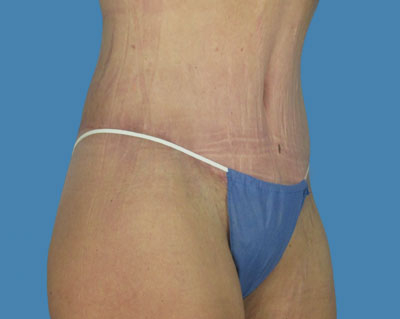 1740677337 body lipotuck p89 row 1 column 2