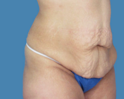 1740677339 body lipotuck p88 row 1 column 1
