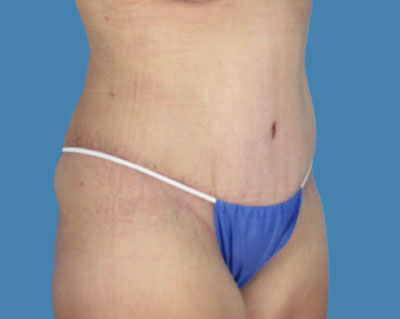 1740677349 body lipotuck p88 row 1 column 2