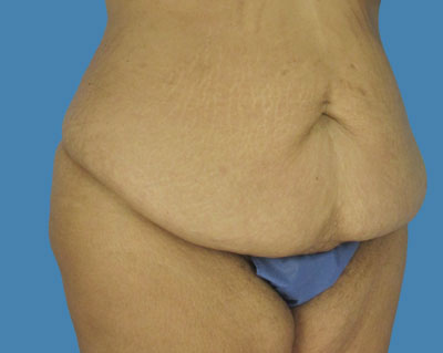 1740677355 body lipotuck p23 row 1 column 1