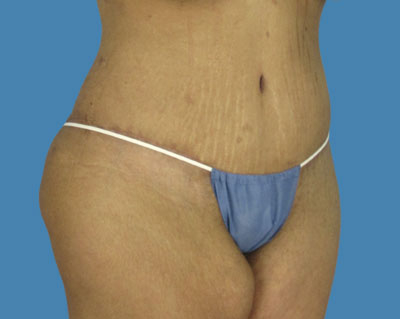 1740677358 body lipotuck p23 row 1 column 2