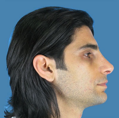 1740677369 face rhinoplasty p4 4 row 1 column 2
