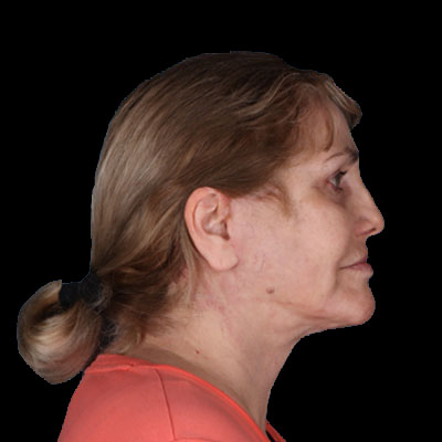 1740677375 Necklift after 318879