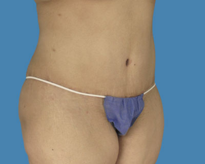 1740677387 body lipotuck p113 row 1 column 2