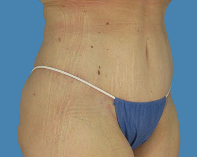 1740677390 body lipotuck p10 row 1 column 2